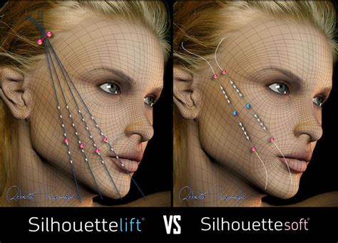 Silhouette Soft Thread Lift .